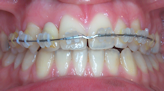 Appareil dentaire orthodontie Courbevoie 
