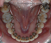 Appareil traitement orthodontique Courbevoie